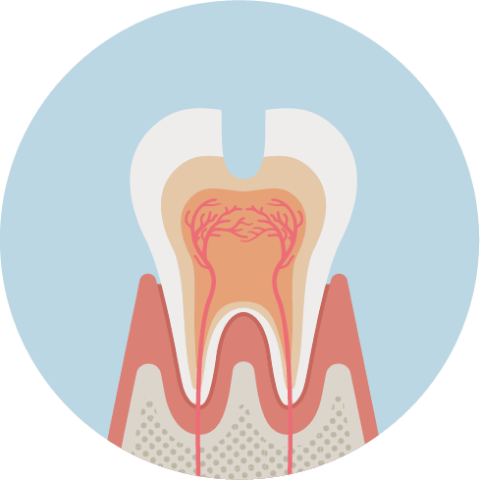 象牙質まで進んだ虫歯