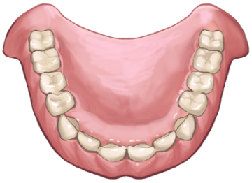 総入れ歯