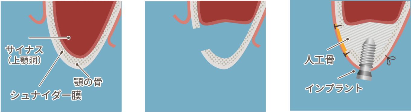 サイナスリフト