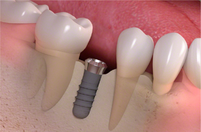 インプラント埋入手術