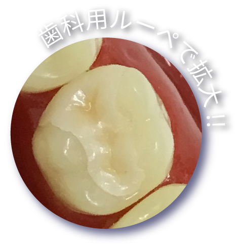 歯科用ルーペで拡大