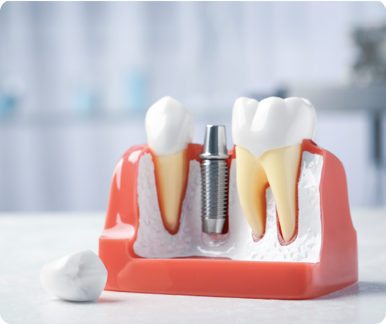 インプラント治療