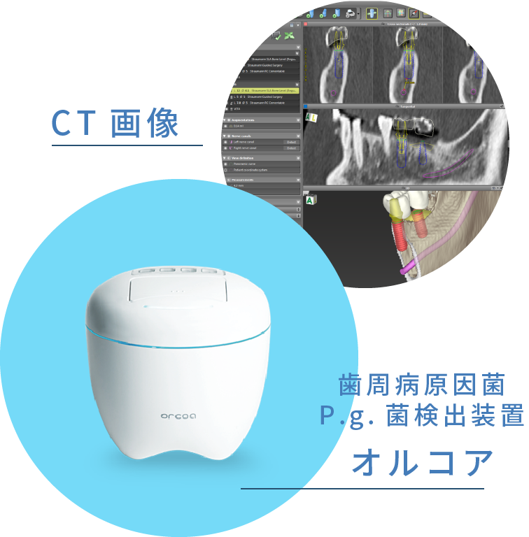 CT画像、歯周病原因菌p.g.菌検出装置オルコア