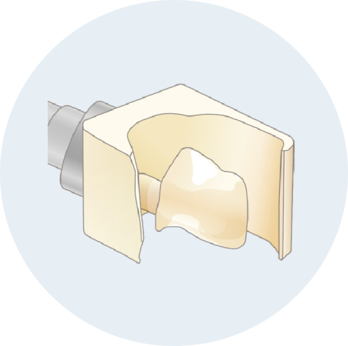 CADCAMインレー/CADCAMクラウン