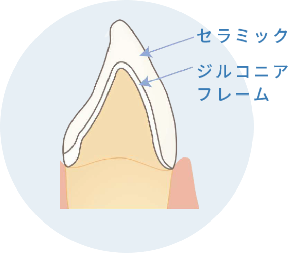 セラミックインレー/オールセラミッククラウン