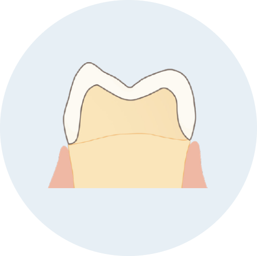 ジルコニアインレー/ジルコニアクラウン