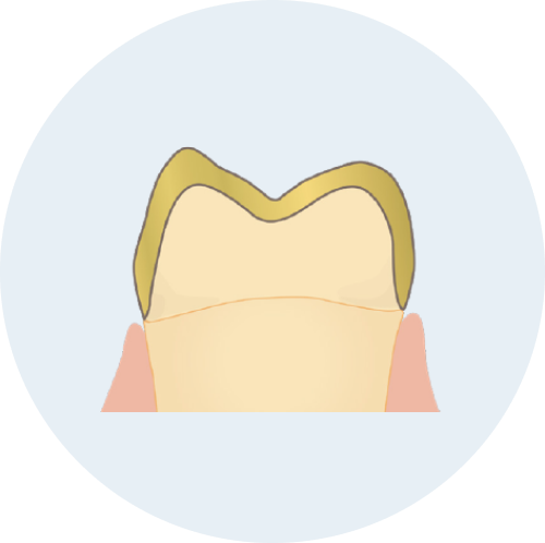 ゴールドインレー/ゴールドクラウン