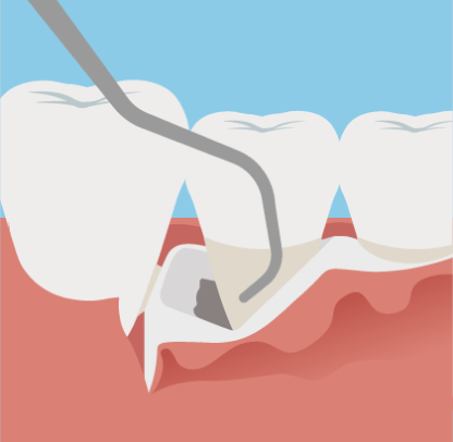 歯肉の剥離・清掃