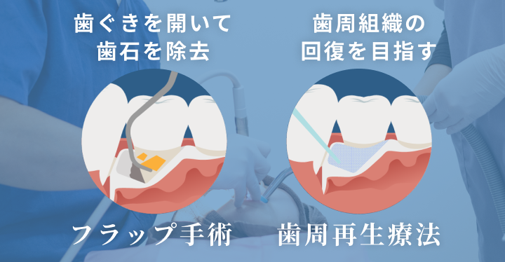 フラップ手術・歯周再生療法