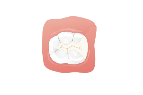ジルコニアインレー