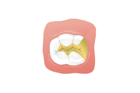 ゴールドインレー