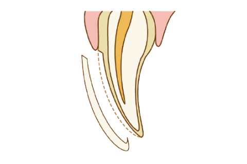 ラミネートベニア