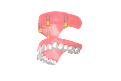 インプラントオーバーデンチャー